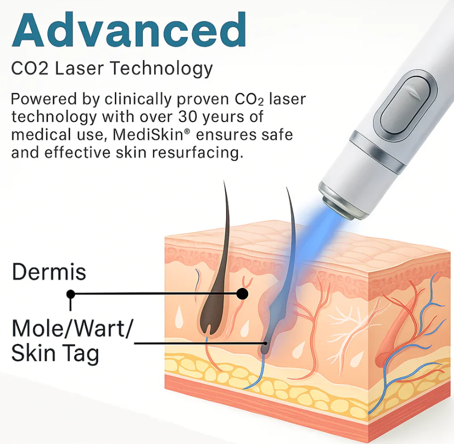 Capry® Mole And Wart Removal Laser Pen