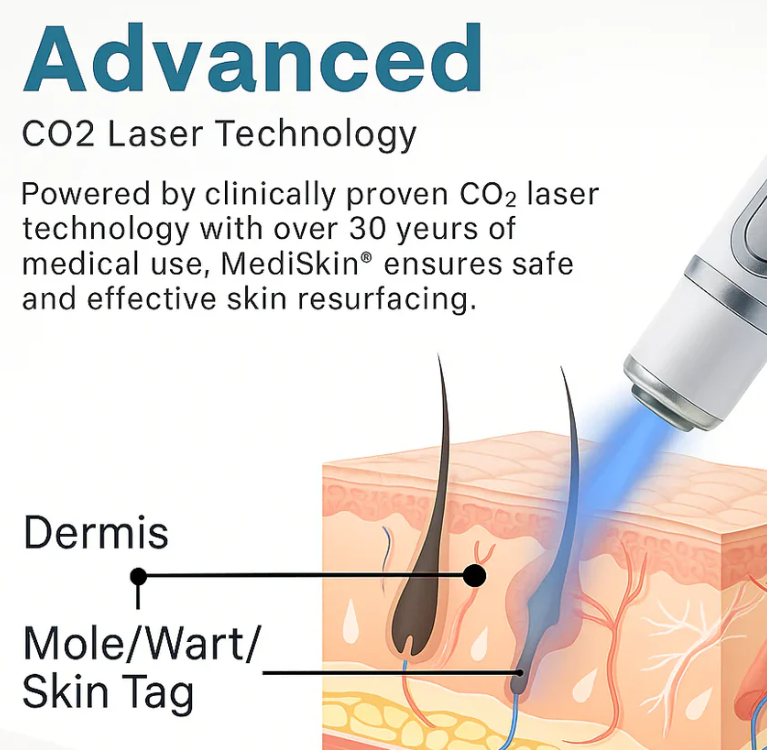 Mole & Wart Removal Laser Pen
