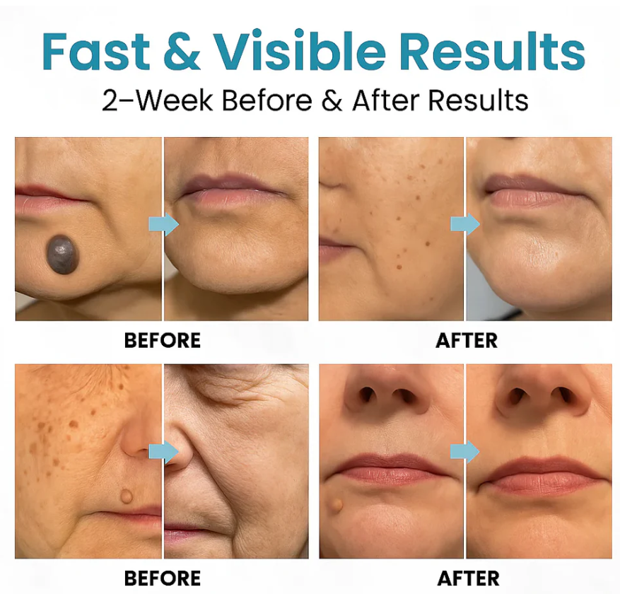 Capry® Mole And Wart Removal Laser Pen